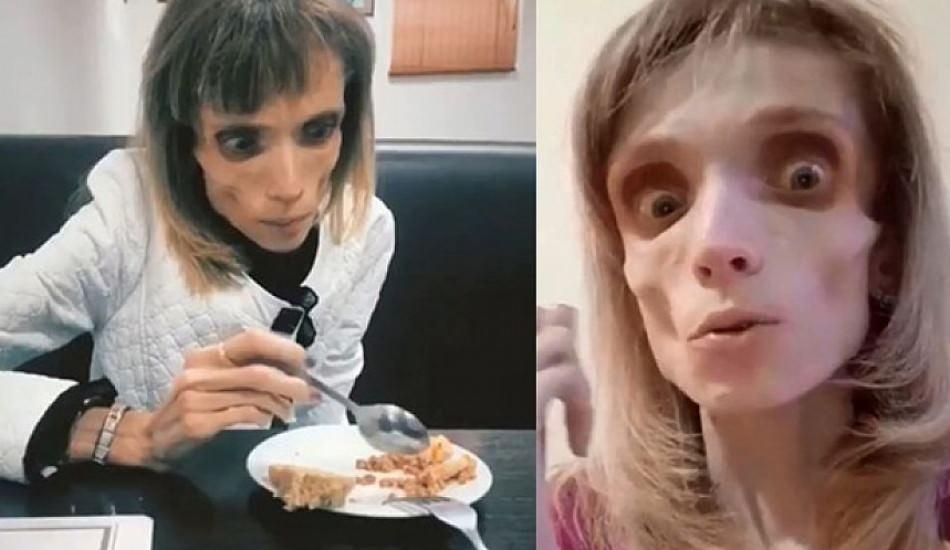 anoreksiya_hastaligi_nedir_anoreksiya_nervoza_belirtileri_nelerdir_anoreksiya_tedavisi_1608537475_3142.jpg