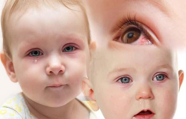 bebeklerde göz kanlanması neden olur