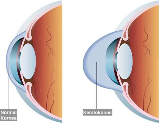 keratokonus nadiren görülen bir göz hastalığı