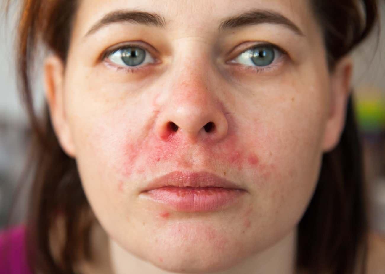 HOW DO pimple on lip SIDES TRANSFER?