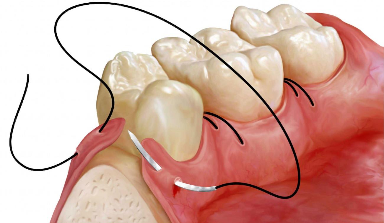 ağız içi kokusu diş eti çekilmesiyle oluşabilir