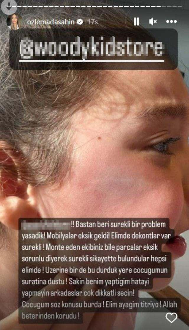 Berkay Şahinin kızının yüzüne dolap kapağı düştü