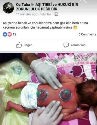 Yeni Doğan Bebeklere Hacamat Uygulaması Üzerine Soruşturma