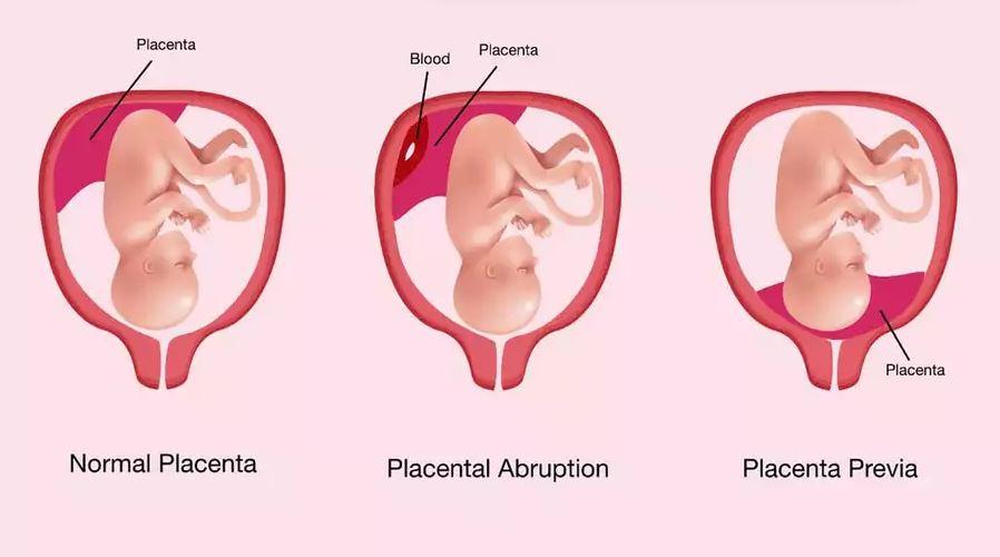 Dekolman Plasenta Risk Faktörleri