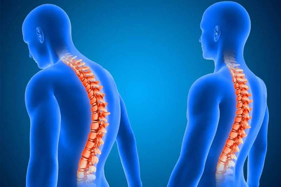 Kamburlaşan iskelet sistemi 