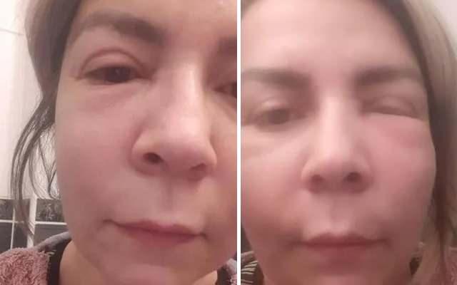 Yanlış estetik uygulama yapılan kadının görseli