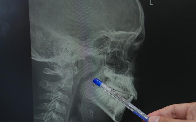 Eğer çocuğunuzun bademcikleri ve geniz eti solunum yolunu daraltarak uykuda nefes durmasına (apne), horlamaya veya sürekli ağız açık uyumaya neden oluyorsa, dikkat edilmesi gereklidir.