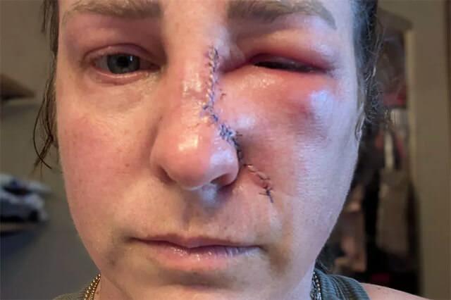 Amanda Andersonun ameliyat sonrası dkiş atılmış hali