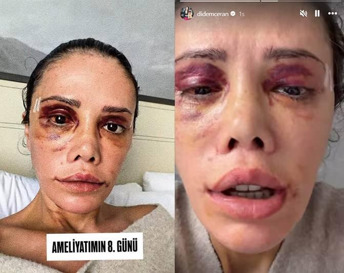Didem Ceran son halini paylaştı