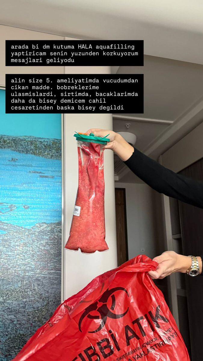 Danla Bilicin 5. ameliyatından çıkan dolgu malzemesi