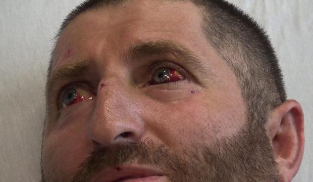 Erzincan'da y&uuml;ksek gerilim hattında dehşet! V&uuml;cudunun 3'te 1'i yandı