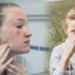 Bu hastalıklara sahipseniz güneş alerjisi riskiniz daha fazla!
