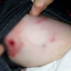 Tekirdağ’da sahipli pitbull vahşeti: 10 yaşındaki çocuk bacağından ısırıldı