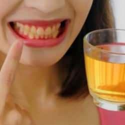 Çay yüzünden sararan dişlere çözüm: Diş lekeleri nasıl geçer? 