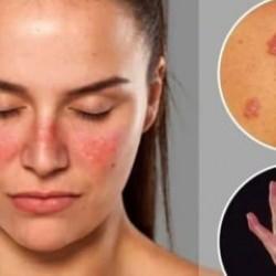 Lupus hastalığı ölümcül müdür, neden olur? Lupus hastalığı tedavisi nedir?