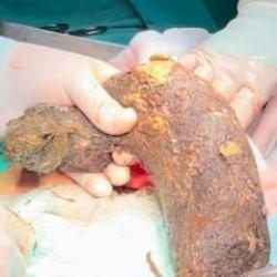 Karın ağrısıyla hastaneye gitti, midesinden 50 santim saç çıktı!