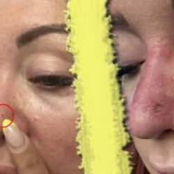 Sıradan bir sivilce sandı, gerçek ortaya çıkınca şoke oldu! O küçük şişlik meğerse...