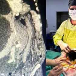 Doktor şaştı kaldı: Dünya literatüründe yok! 90 santimetrelik kedi-köpek kisti çıkarıldı!