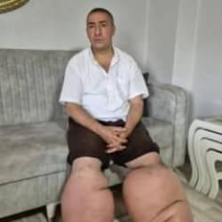 15 yıldır fil hastalığıyla mücadele ediyor