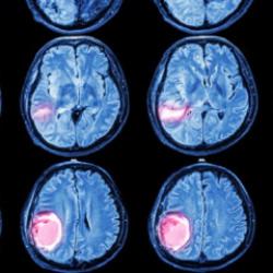 Beyin tümörlerinde 3 kritik sinyal!