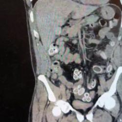 Fas’tan Beşiktaş'a midesinde uyuşturucu getirdi: Ameliyatla çıkarıldı 