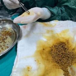 Karın ağrısı şikayetiyle gitti, vücudundan 2 bin 67 tane taş çıktı