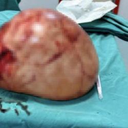 Van'da tıp d&uuml;nyasını şaşırtan operasyon: Karnından 35 santimetrelik kitle &ccedil;ıktı