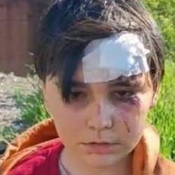K&uuml;tahya'da başıboş k&ouml;pek dehşeti! 2 &ccedil;ocuk saldırıya uğradı