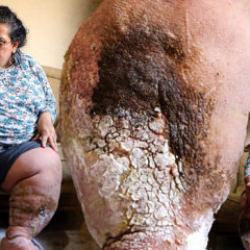 Fil hastası annenin &ccedil;aresiz &ccedil;ığlığı: &Ccedil;ocuklarım i&ccedil;in yaşamak istiyorum