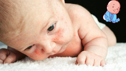 Bebeklerde isilik nasıl geçer? İsilik olan bebeklerde doğal çözümler ve isilik nedenleri