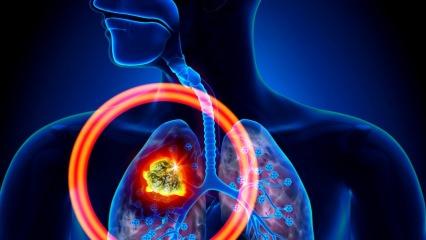 Akciğer kanserinin belirtileri nelerdir? Akciğer kanseri tedavisi var mıdır?