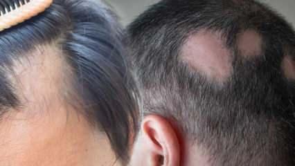 Saçkıran (Alopesi areata) nedir? Saçkıran belirtileri neler? Saçkıran için etkili çözümler