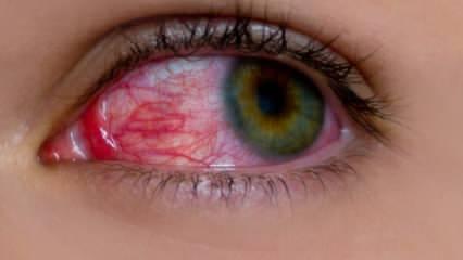 Göz alerjisi neden olur? Göz alerjisinin belirtileri nelerdir? Göz alerjisine ne iyi gelir? 