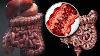 Crohn hastalığı nedir? Crohn hastalığının belirtileri nelerdir? 