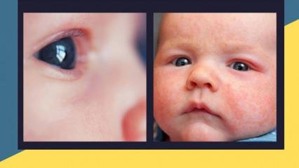 Bebeklerde göz kızarıklığı ve kaşıntı nedenleri! Bebeğinizin gözleri sulanıyorsa...