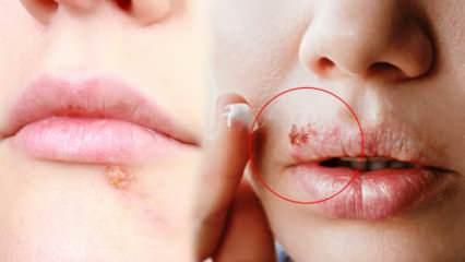 Uçuğu hızlı geçirmek için evde ne yapılır? 1 gecede uçuğu geçirmenin yolları