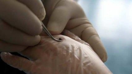 Tokat'ta, 3'ü çocuk 5 kişi KKKA hastalığı teşhisiyle tedavi görüyor 