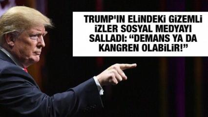 Trump'ın elindeki gizemli izler sosyal medyayı salladı: “Demans ya da kangren olabilir!”