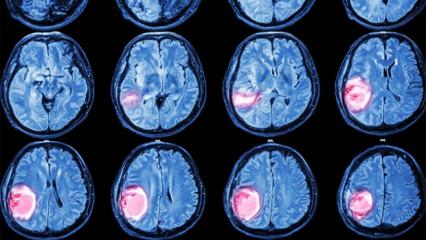 Beyin tümörlerinde 3 kritik sinyal!