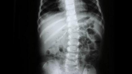 Omurga sağlığı i&ccedil;in nelere dikkat edilmeli? Uzman isim a&ccedil;ıkladı 