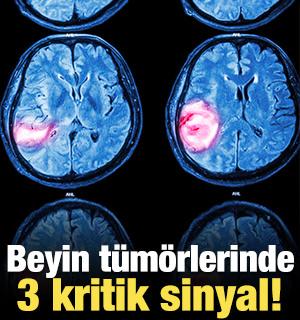 Beyin tümörlerinde 3 kritik sinyal!