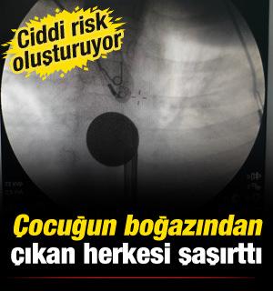 G&ouml;ren inanamadı! 8 yaşındaki &ccedil;ocuğun boğazından &ccedil;ıkartılan şaşırttı
