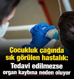 &Ccedil;ocukluk &ccedil;ağında sık g&ouml;r&uuml;len hastalık: Tedavi edilmezse organ kaybına neden oluyor