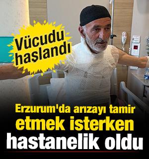 Erzurum'da arızayı tamir etmek isterken hastanelik oldu