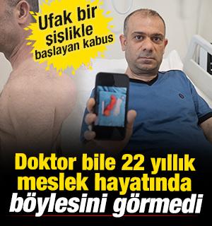 Sırtındaki şişliği &ouml;nemsemedi! Yıllar i&ccedil;inde b&uuml;y&uuml;d&uuml;! Doktorları şoke eden vaka