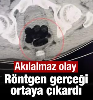 R&ouml;ntgen ger&ccedil;eği ortaya &ccedil;ıkardı: Midesinden 35 par&ccedil;a eroin &ccedil;ıktı